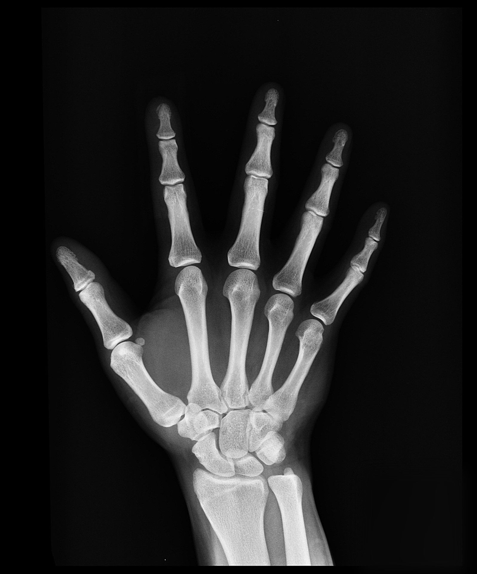 Yepa! I don break my hand o!